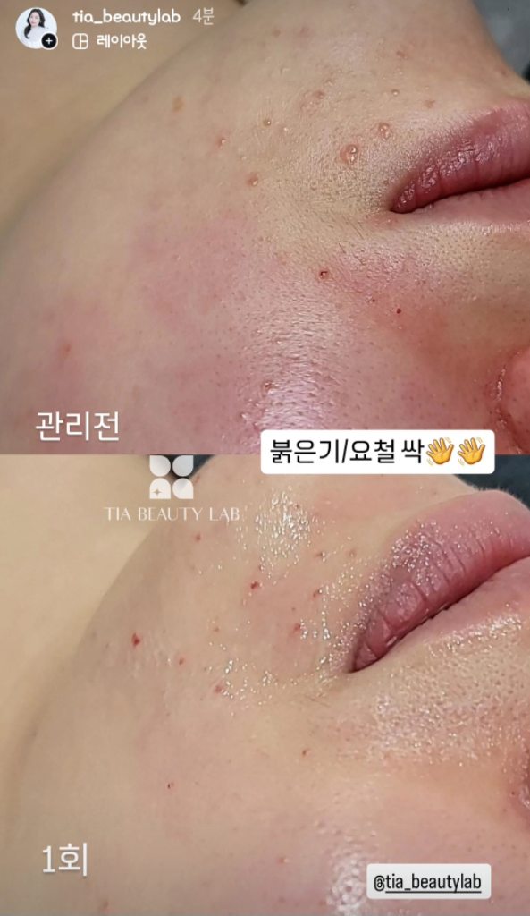 팔로우픽 - followPick | 문제성스킨케어/피부요철,지루각화케어,비립종,쥐젖